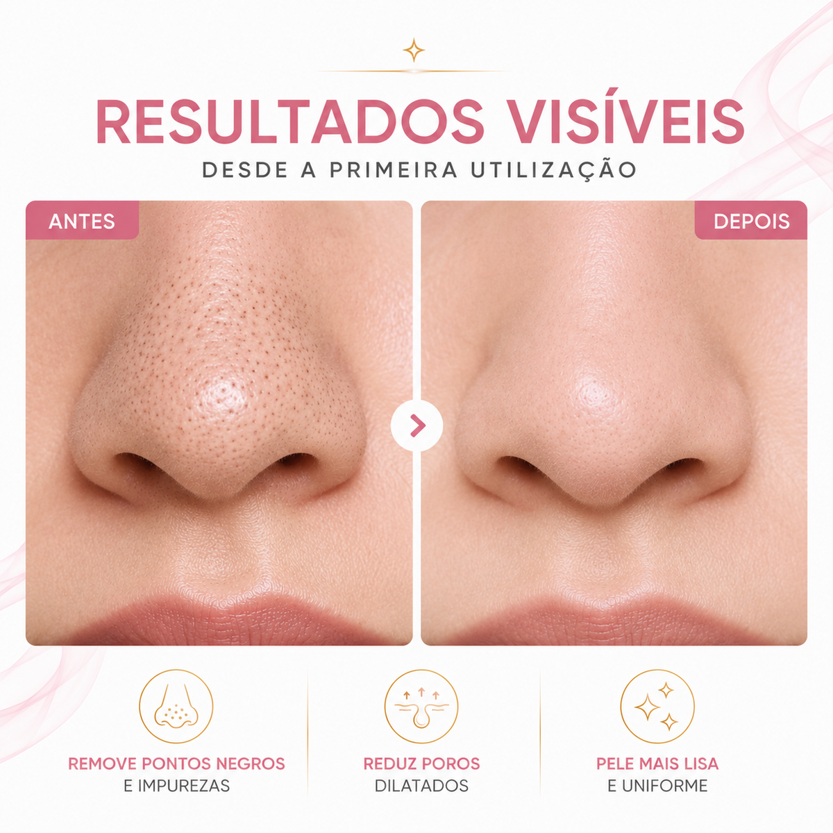 Removedor de Cravos e Espinhas PoreClean Pro™ + Sérum Antiacne GRÁTIS