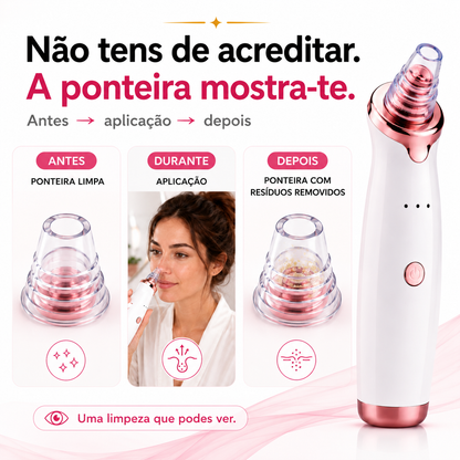 Removedor de Pontos Negros e Impurezas Profissional - PoreClean Pro™